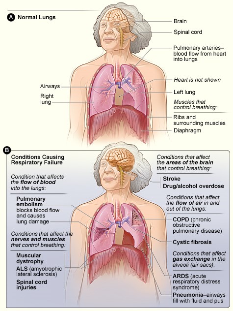 acute-respiratory-insufficiency-failure-practical-skills-in