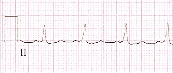 tachycardia_4.jpg