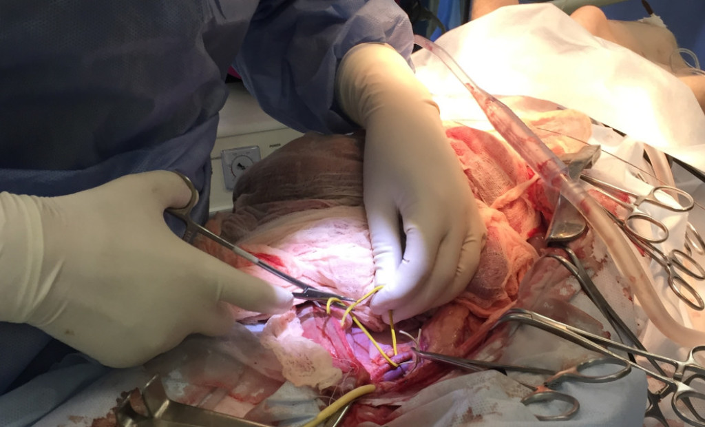 Інтерни та студенти ПДМУ здійснили ауто-гетеротопічну трансплантацію нирки свині