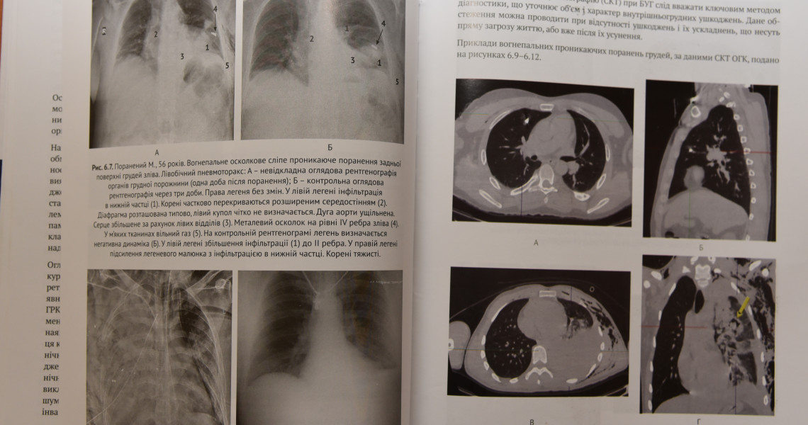 «Лікування поранених з бойовими ушкодженнями грудей»: монографія за участю науковців ЗВО ПДМУ у широкому доступі