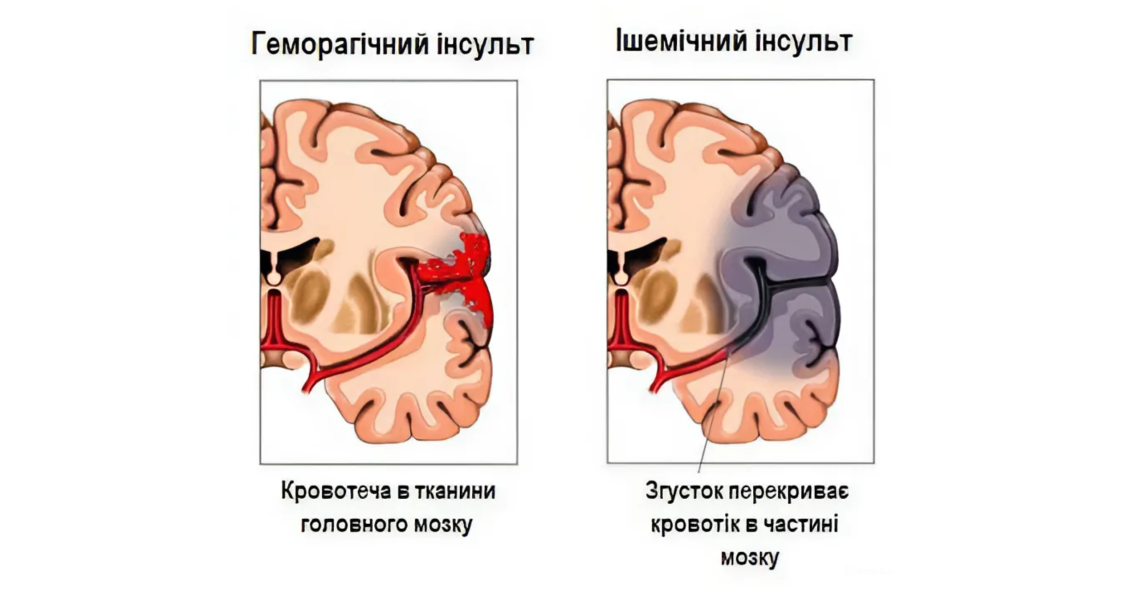 Основні причини і симптоми інсульту: студенти обговорили на занятті / Main Causes and Symptoms of Stroke: Students Discussed in Class