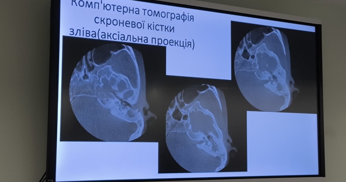 Всеукраїнська конференція "Полтавський оториноларингологічний форум - 2024": підсумки / The All-Ukrainian Conference "Poltava Otorhinolaryngology Forum - 2024": summary