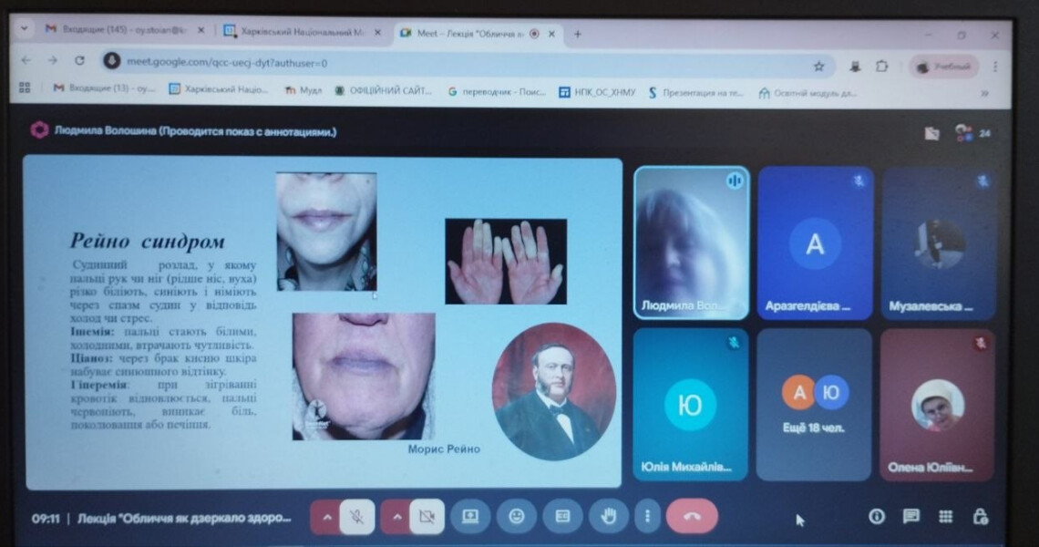 У ПДМУ відбулася лекція про щелепно-лицеві прояви ендокринних і серцево-судинних захворювань для слухачів ХНМУ